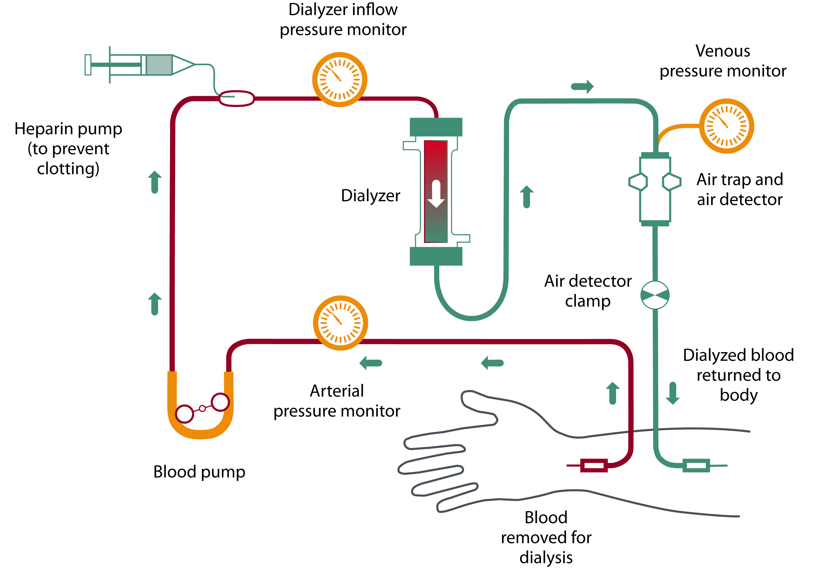 Hemodialysis circuit schematic showing dialyzer, blood pump, and pressure monitors
