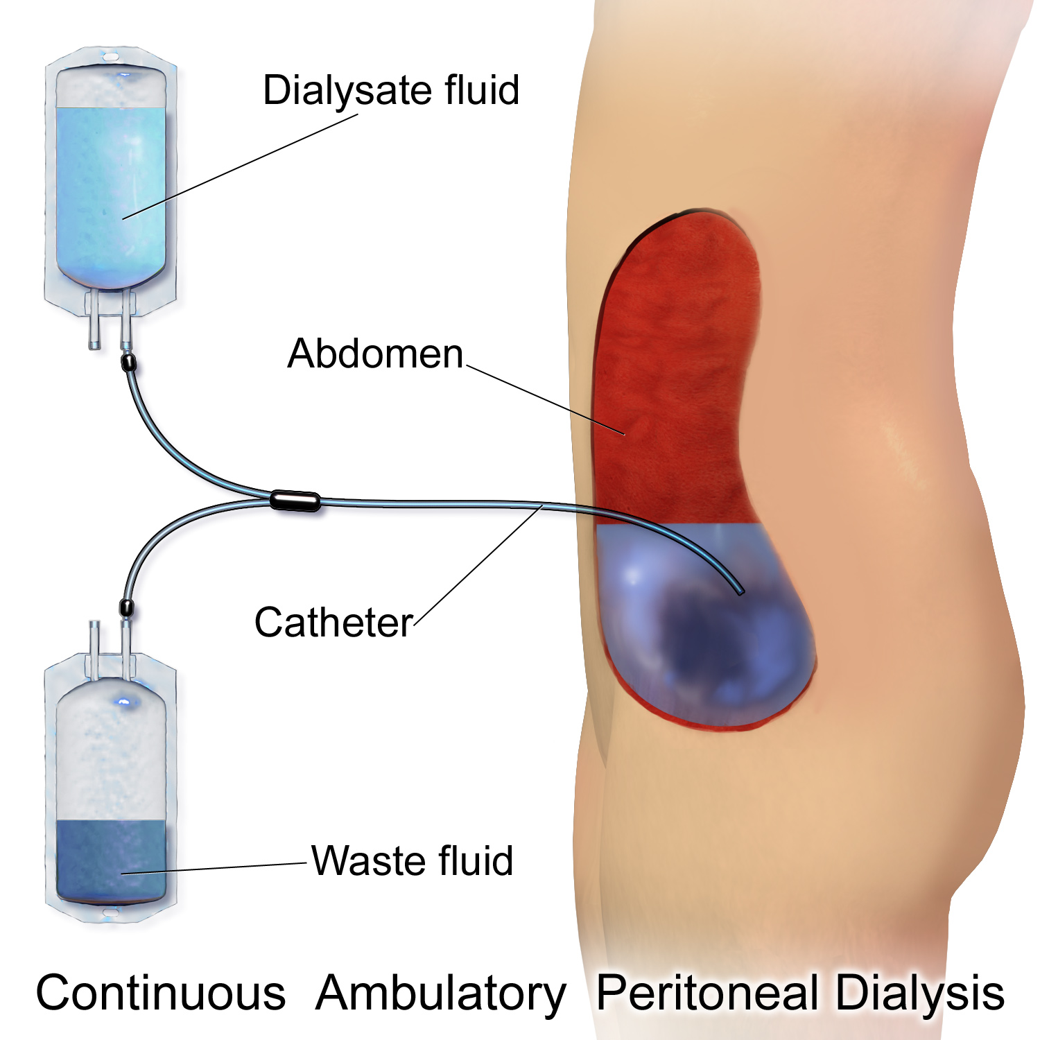 Diagram showing how continuous ambulatory peritoneal dialysis (CAPD) works with dialysate fluid flowing through the abdomen