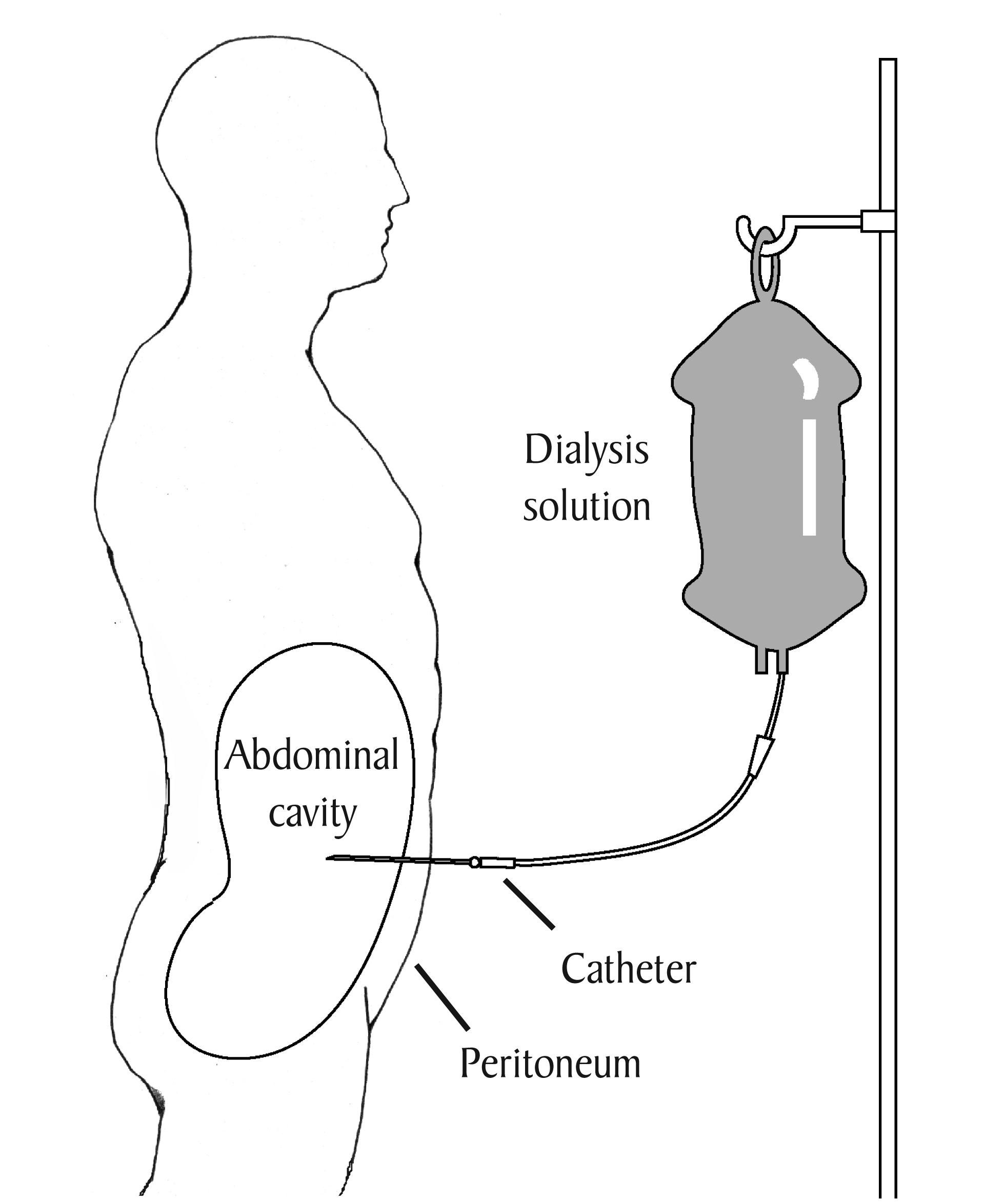 Peritoneal dialysis process diagram showing catheter, peritoneum, and dialysis solution